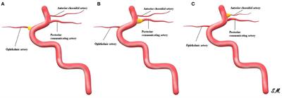 Flow Diversion for the Management of Ruptured Intracranial Arterial Infudibular Dilatation: Proof of Principle and Therapeutic Protocol